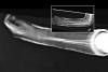AP and lateral  X-ray of left double bone forearm fractures closed reduced and immobilized in a long arm cast. 