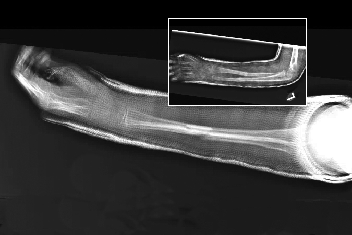 AP and lateral  X-ray of left double bone forearm fractures closed reduced and immobilized in a long arm cast. 
