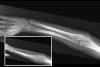AP and lateral  X-ray of left double bone forearm fractures healed and remodeling.