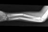  X-ray AP view of left transverse angulated double bone forearm fractures in middle third of the forearm in a six year male child.