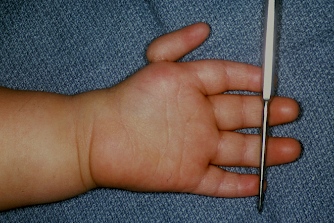 Left Hypoplastic Thumb Type 4 [ Flottant (Floating Left Thumb) ]