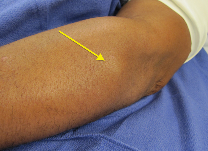 Lipoma Proximal Dorsal Forearm with PIN Palsy