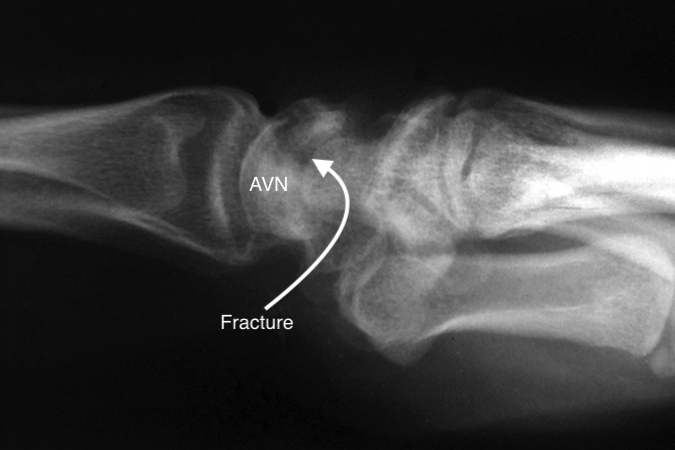 Lunate dorsal lip fracture (arrow) associated with avascular necrosis (AVN) of the lunate