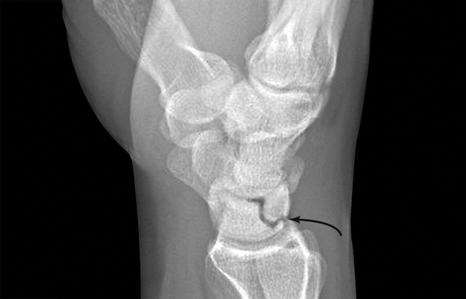 Non-displaced dorsal lip lunate fracture (arrow)