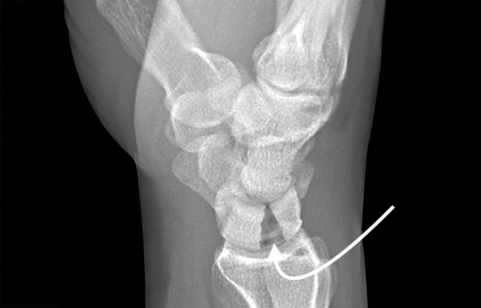 Displaced lunate fracture (arrow)