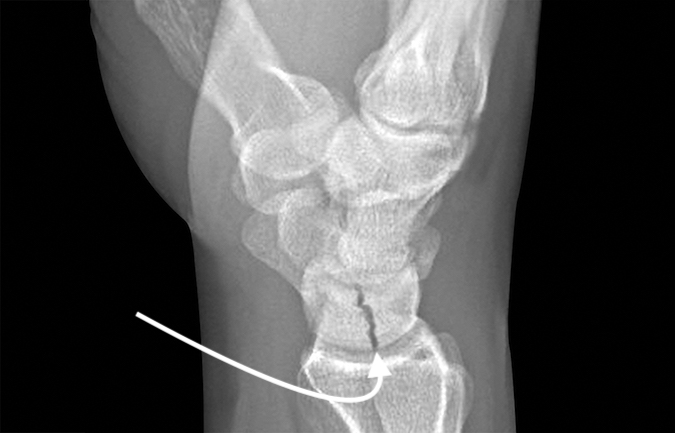 Non-displaced lunate fracture (arrow)