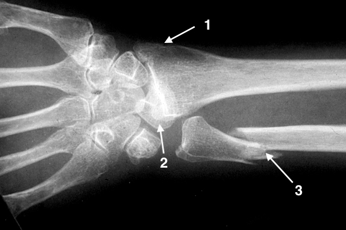 Right lunate dislocation AP X-ray: 1- radial styloid fracture; 2- volarly displaced triangular lunate; 3- ulna fracture.