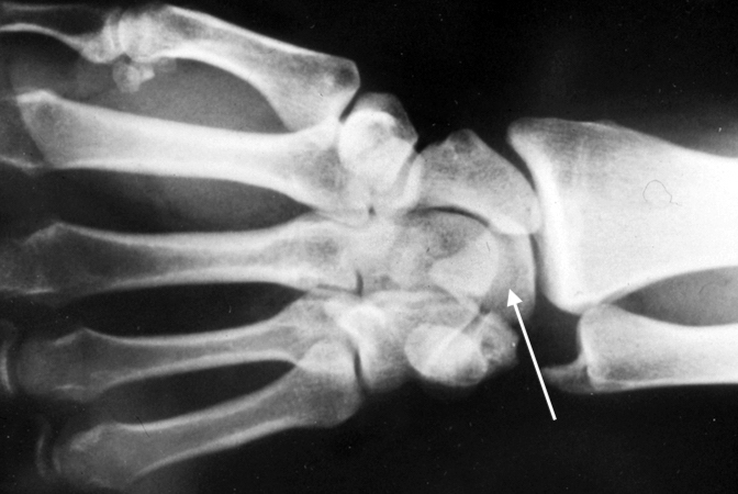 Left lunate dislocation AP X-ray volarly displaced triangular lunate (arrow) with "piece of pie" sign and disrupted Gilula's lines
