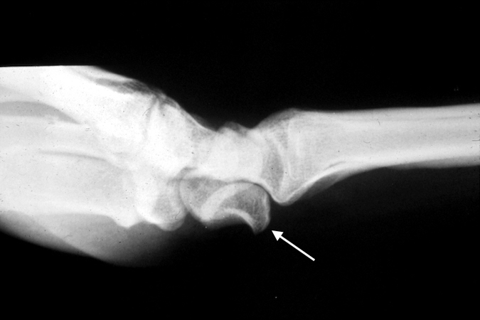Left lunate dislocation lateral X-ray volarly displaced lunate (arrow)  with a "spilled tea cup" sign.
