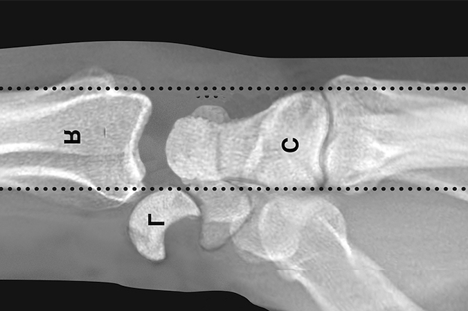 Diagrammatic lateral x-ray of a lunate dislocation.  R-radius; C-capitate, and L-lunate.