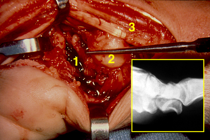 Open reduction of volar lunate dislocation (insert) with carpal tunnel release. Note 1- volar capsular ligament tear; 2- lunate in carpal tunnel; 3- retracted flexor tendons and median nerve.