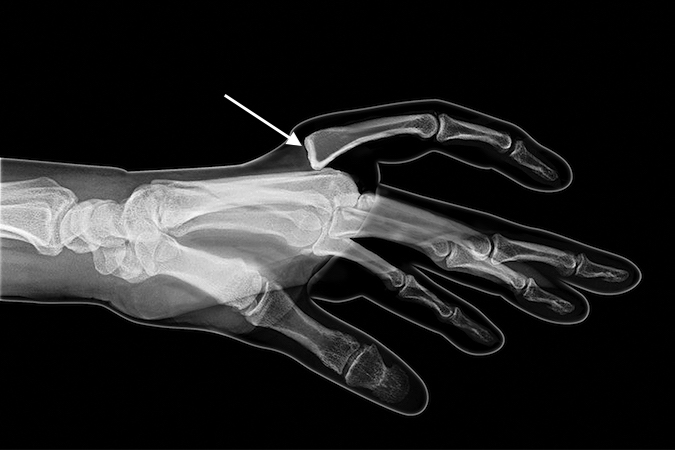 Index MP dorsal dislocation. With this bayonet position there is a possibility that the volar plate is dorsally displaced or in the joint and will block a closed reduction, i.e. a complex dislocation.