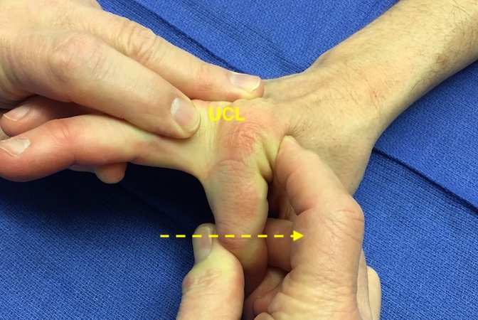 Testing index MP joint ulnar  collateral ligament (UCL) after reduction of dislocation.  Force being applied in the direction of the  arrow.