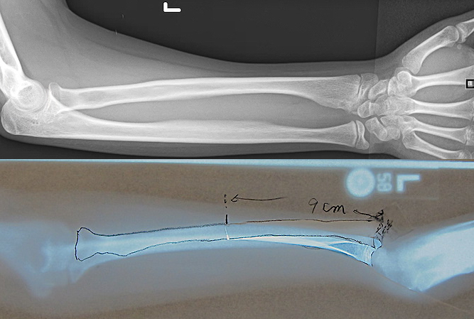 Madelung’s deformity of left wrist in 11 year old female. Tracing paper used to define wedge size and location.