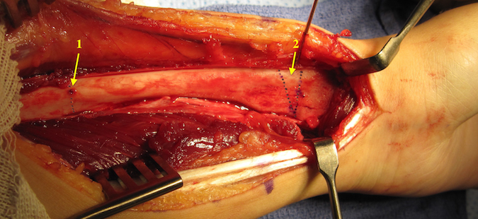 Madelung’s deformity of left wrist surgical exposure with closing distal wedge and opening radial shaft wedge.