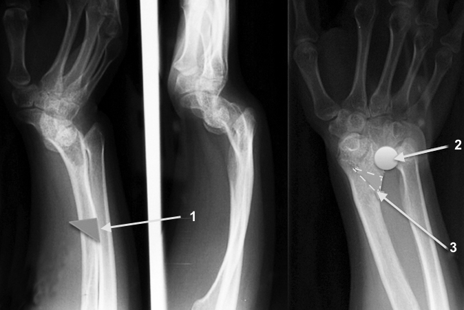 Osteoplasties of the right distal radius and right radial shaft. The radial shaft's dorsal apex angulation (bowing) will be corrected with a closing wedge osteoplasy (1).  The Vicker's ligament when present must be released (2 circle).  The distal radius deformity will be corrected by a biplantar osteoclasts (3).  The osteotomy will be opened ulnarly and volarly.