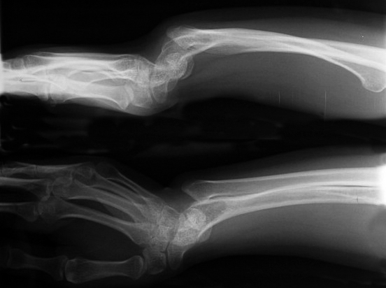 Madelung’s AP X-ray right wrist