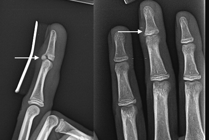 Distal Phalanx splinted mallet fracture  (arrow) with acceptable reduction