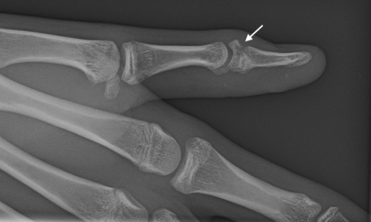 Thumb distal phalanx mallet fracture through closing growth plate