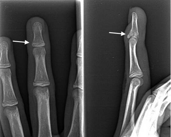 Distal Phalanx Mallet fracture in young teenager with open growth plates (arrow)