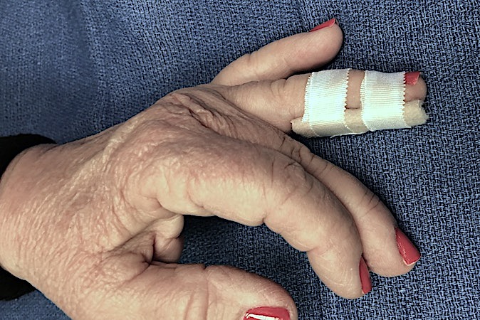 Lateral view of palmar mallet finger splint for right ring finger