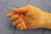 Right handed 62 y.o. male complaining of weak pinch and inability to flex thumb and index
