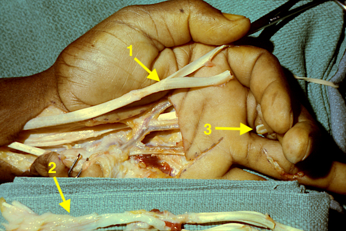 Chronic severe RA with multiole flexor tendon ruptures (I,II,III): 1 -Ring FDS for FPL reconstruction; 2 - Excised not salvageable flexor tendons; 3 - Palmar longus (PL) graft for ring flexor tendon reconstruction
