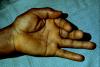 Male with long standing RA complaining of poor pinch and grip. He can not flex the thumb, index or long fingers.