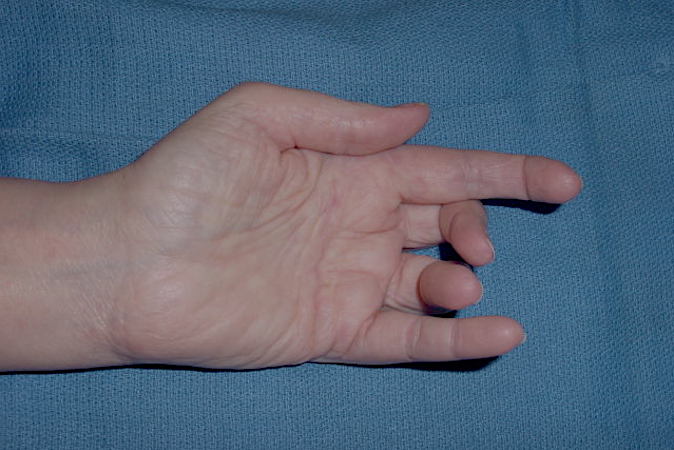 Right handed female with arthritic index DIP and sudden loss of thumb flexion.