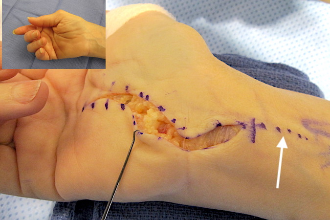 Incision for tenosynovectomy and flexor tendon reconstruction with second incision for harvesting PL graft (arrow)