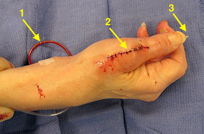 Mannerfelt surgical reconstruction complete: 1 - drain in carpal tunnel; 2 - incision for MP joint arthrodesis; 3 - K-wire fixation for MP joint arthrodesis