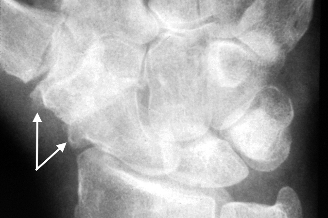 Oblique wrist X-ray showing osteophytes that caused attritional FPL rupture
