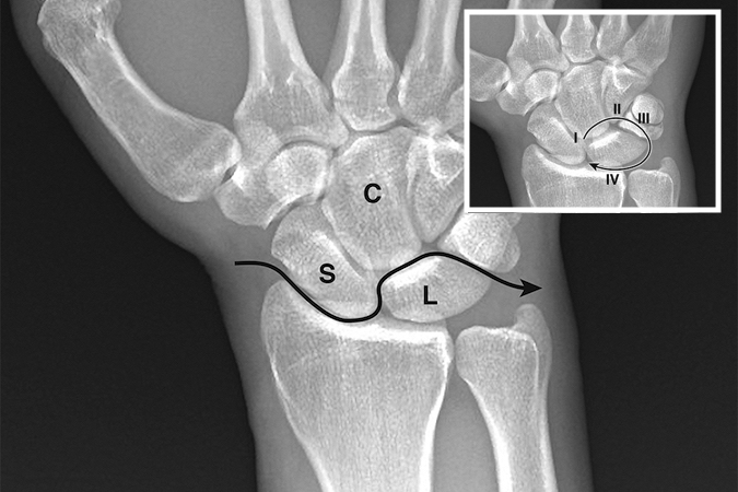 The lesser arc injuries described by Mayfield (ref 32) that are associated with ligamentous injuries that lead to rotatory subluxation of the scaphoid, perilunate, and lunate dislocations.  The arrow shows the path of the forces through first three stages.  The insert shows the full four Mayfield lesser arc injury stages.
