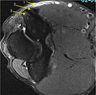 Medial epicondylitis with 1-subcutaneous edema; 2- tendinopathy; 3- edema in medial epicondylar bone