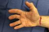 Most median nerve palsies are secondary to chronic carpal tunnel syndrome or median nerve lacerations where recovery after nerve repair is incomplete or fails.