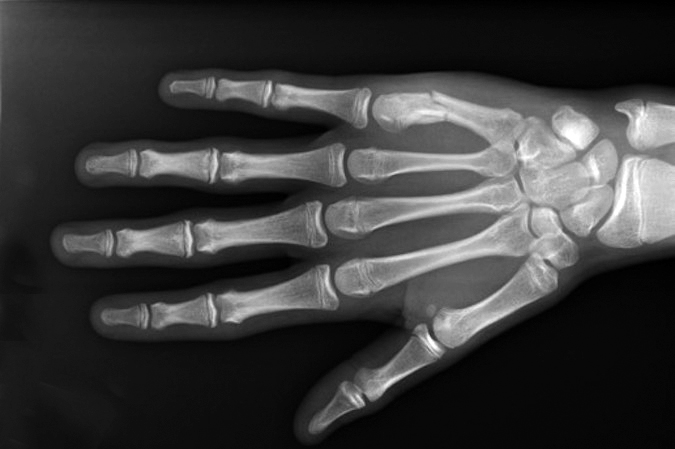 Fifth metacarpal shaft fracture AP