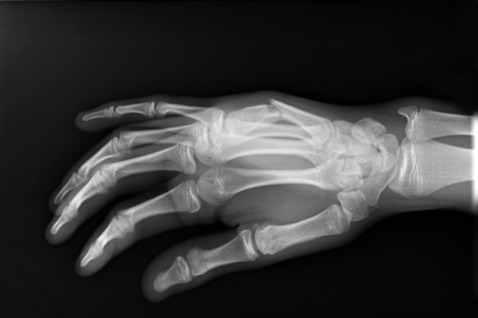  Fifth metacarpal shaft fracture Lateral with significant dorsal apex angulation with prior closed reduction that displaced in a splint.