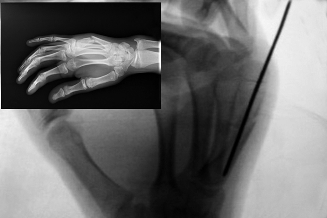  Fifth metacarpal shaft fracture Lateral with significant dorsal apex angulation with failed closed reduction that displaced in a splint.  Now being treated with closed reduction and percutaneous pinning.