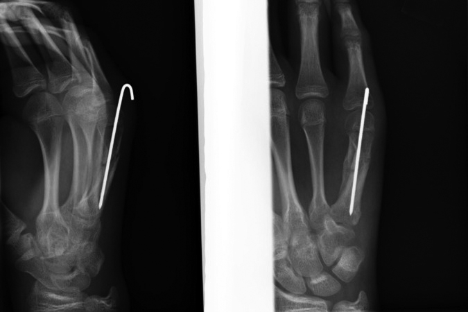  Fifth metacarpal shaft fracture Lateral with significant dorsal apex angulation successfully treated with CRPP.  Note mature callus with remodeling.