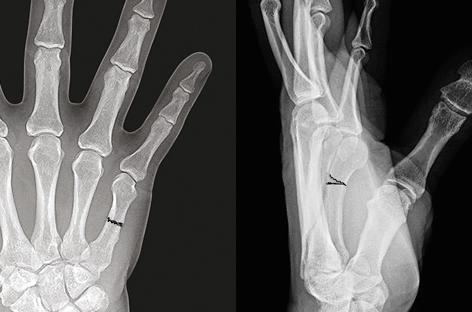 Fifth metacarpal shaft fracture AP, Lateral & oblique with dorsal apex angulation