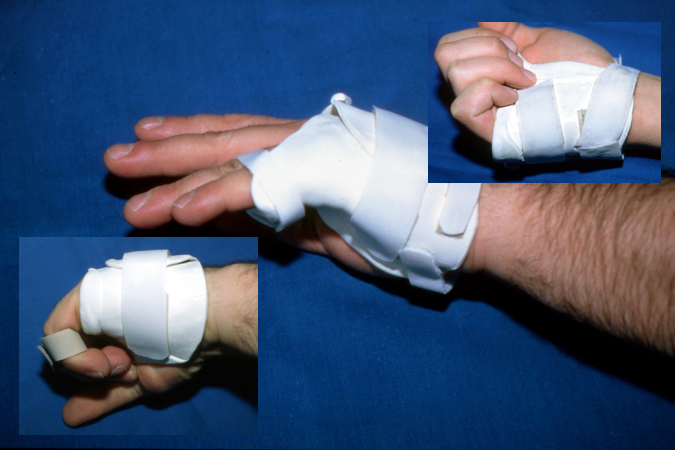 Boxer's Fractures and other metacarpal fractures can be treated in fracture braces which help maintain reductions while allowing early range of motion.