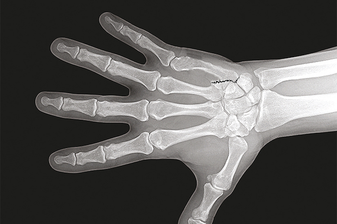 Fifth metacarpal displaced intra-articular "Baby Bennett's" fracture