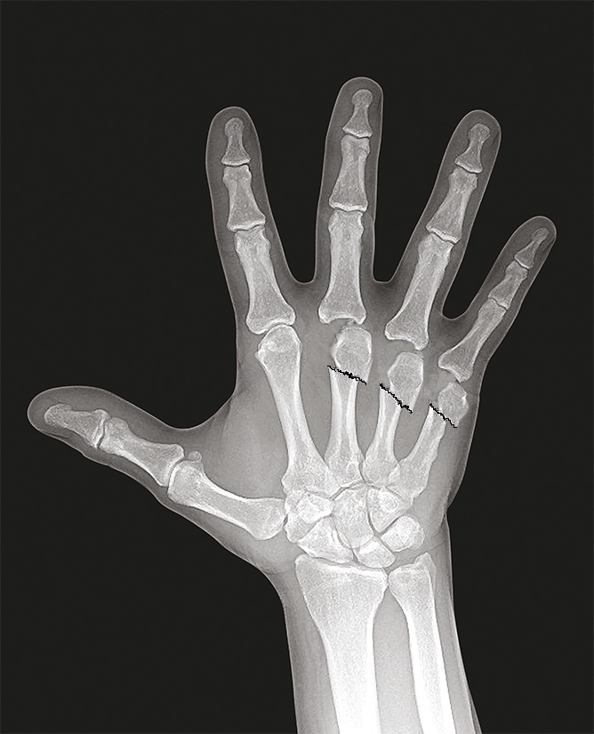 Long, Ring and Little severely displaced metacarpal  head fractures (AP).  Expect significant trauma with marked swelling.