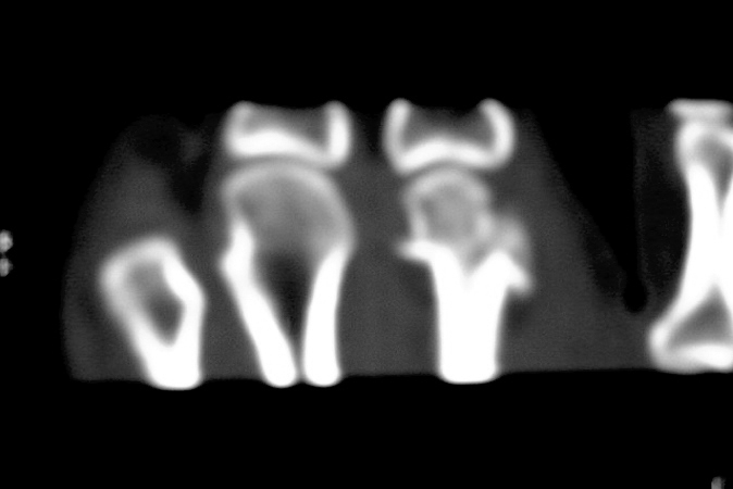 Index metacarpal comminuted fracture CT