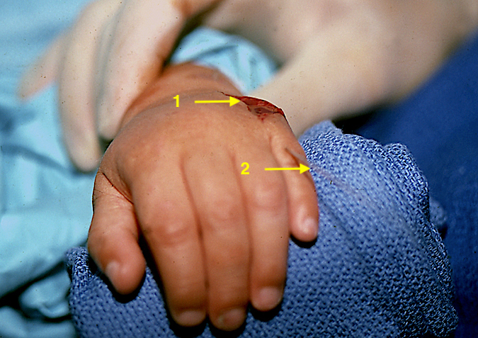 Left Metacarpal Synostosis correction with surgical incision (1) K-wire fixation (2).