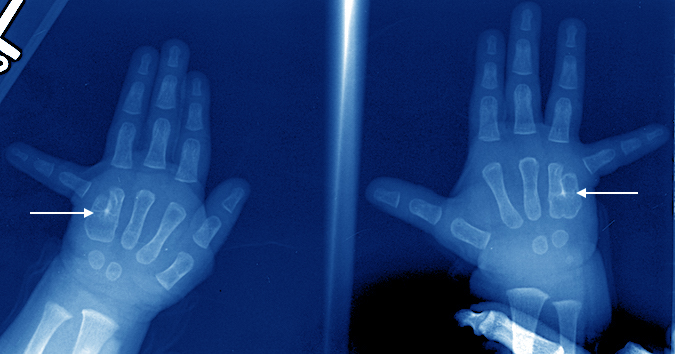 Bilateral Ring-Little Metacarpal Synostosis