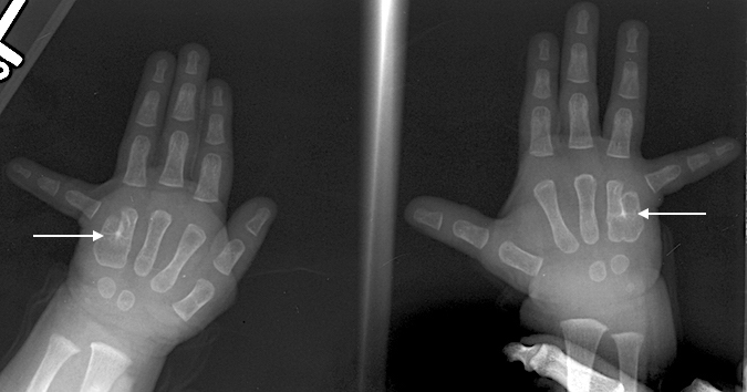 Bilateral partial ring-little metacarpal synostosis