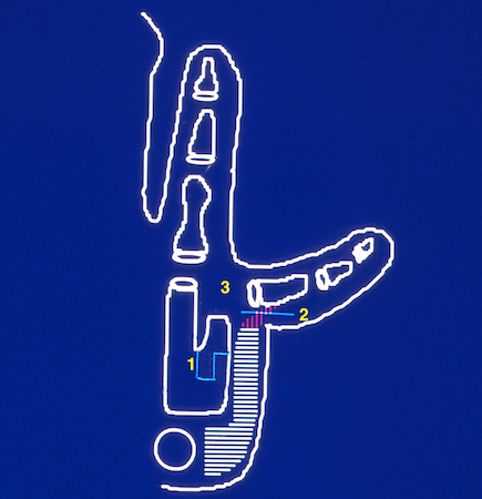 Ring-Little Partial Metacarpal Synostosis : 1-Osteotomies to widen space between metacarpals, length fifth metacarpal, and move distal fifth metacarpal ulnarly;  2- Release conjoined tendon of hypothenar muscles;  3- Tighten fifth MP joint radial collateral ligament.