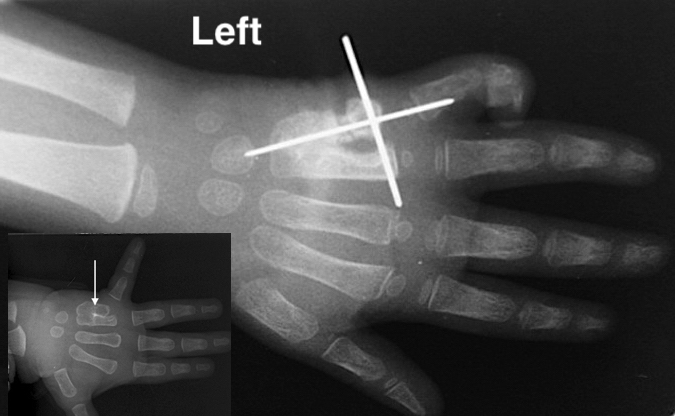 Left Metacarpal Synostosis correction with K-wire fixation after lengthening and ulnarization osteotomy.