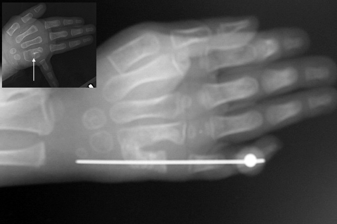 Right Metacarpal Synostosis correction with K-wire fixation after after lengthening and ulnarization osteotomy.